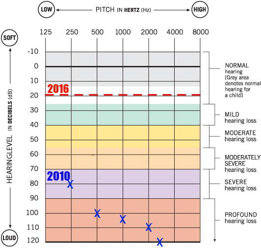 Cochlear Implant Comparison Chart 2016